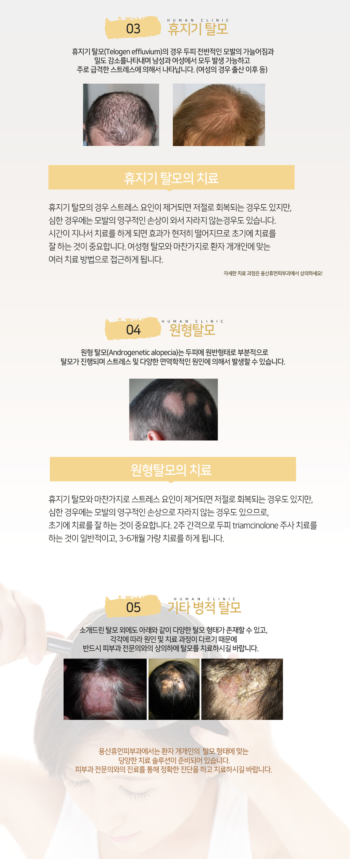 탈모